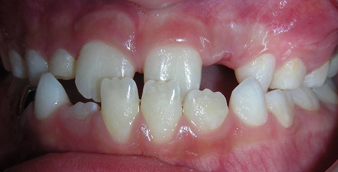 Child's teeth, left side view before orthodontic treatment for an underbite (Negative overjet) 